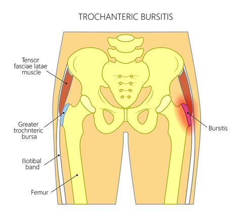 Shockwave Therapy for Greater Trochanteric Pain Syndrome (GTPS)