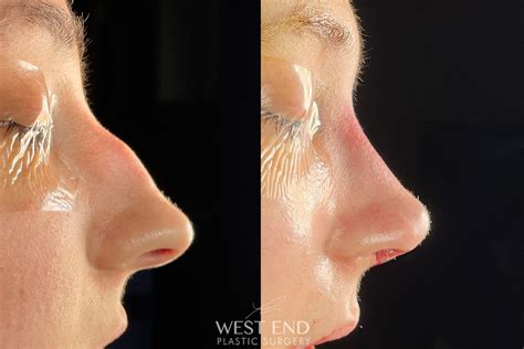 Plastic Surgery Before And After Nose Jobs