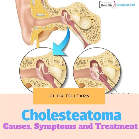 Cholesteatoma - Causes, Picture, Symptoms And Treatment