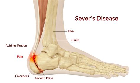 Sever's Disease Symptoms, Causes, Physical therapy Treatment