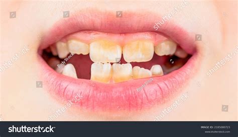 Rotten Baby Teeth Images: Browse 389 Stock Photos & Vectors Free ...