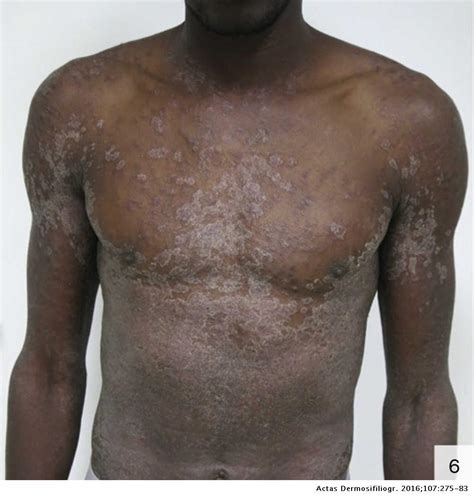 Atypical Cutaneous Manifestations in Syphilis | Actas Dermo-Sifiliográficas