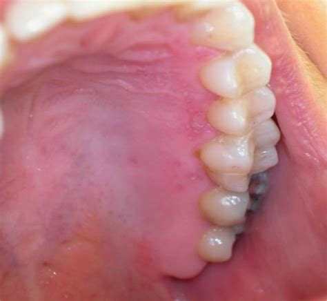 Herpes Simplex Virus (Hsv) Infection Of The Mouth – European Association of Oral Medicine