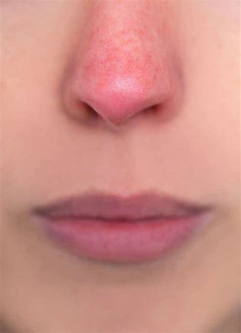 How To Treat Rosacea | How To Reduce Rosacea