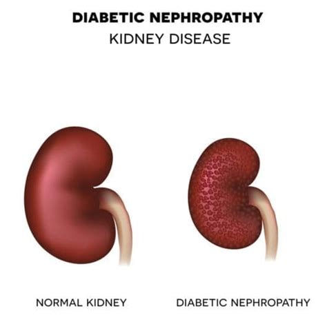 Diabetic Nephropathy - familydoctor.org