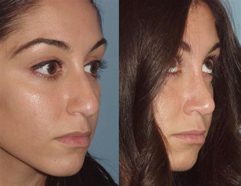 Are you looking for the Best Rhinoplasty Surgeon in Florida? Check our site for ALL the info you ...