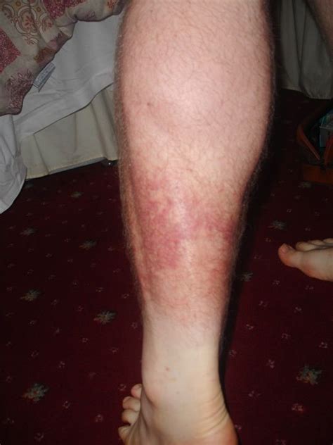 Rash On Calf Of Leg Pictures | Health | Pinterest | Calves, Pictures and Legs