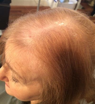 Thinning Hair in Women - Lucinda Ellery Inc. Hair Loss Consultants