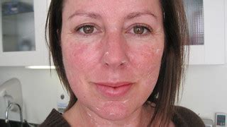 IPL: Intense Pulsed Light Treatment | Before. Just applied a… | Flickr