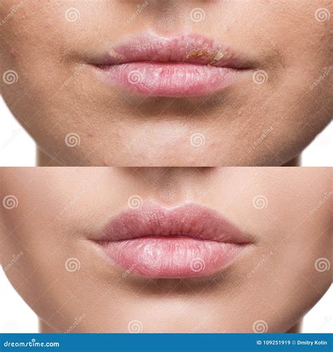 Lips Herpes Pictures at frankkcripps blog