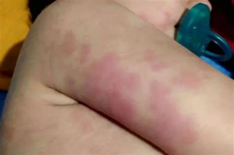 Parents warned to be wary of severe rash that can hit toddlers with ...