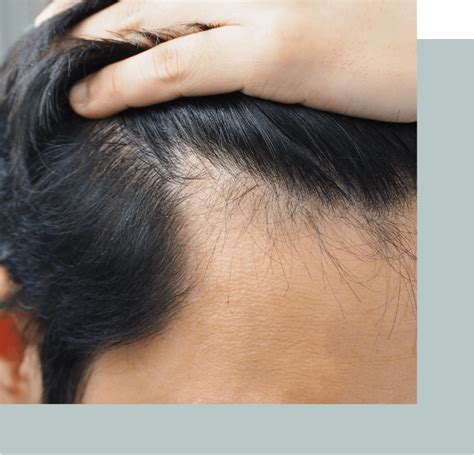 Alopecia in men - Kensington Hair Clinic