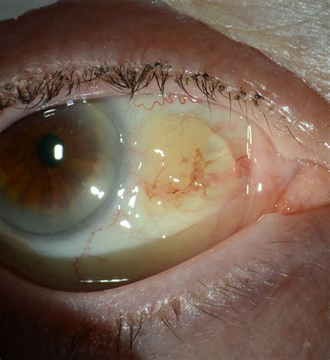 Unveiling ocular surface squamous neoplasia within a conjunctival ...