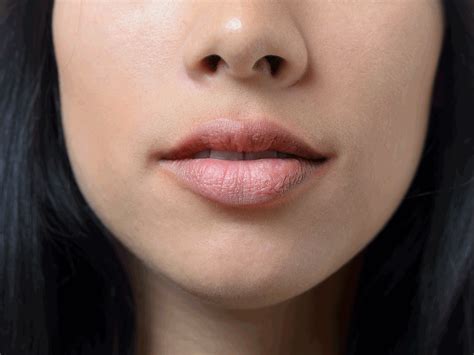 Perioral Dermatitis Might Be What’s Causing Your Red Face Rash in 2021 | Rash on face, Perioral ...