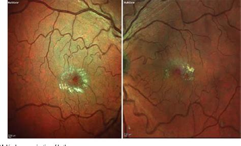 Figure 3 from Diagnosis and management of a patient with idiopathic macular telangiectasia type ...