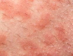 Lamictal Skin Rash May Be an Early Sign of Something Worse - Top Class Actions