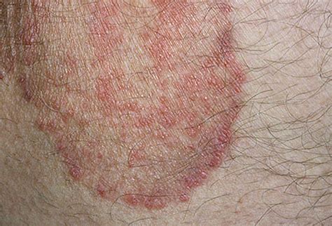 Is itching contagious?