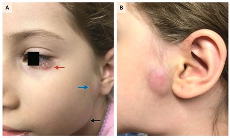 TropicalMed | Free Full-Text | Parinaud’s Oculoglandular Syndrome: A ...