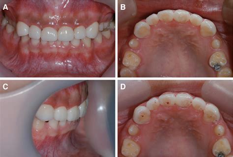 A noninvasive esthetic treatment of isolated microdontia using new high-translucent cubic-phase ...