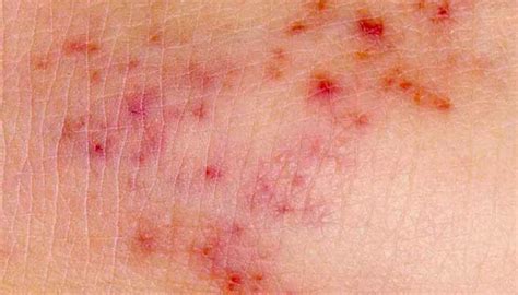 What The Meningitis Rash Looks Like And How To Identify Nine Other ...