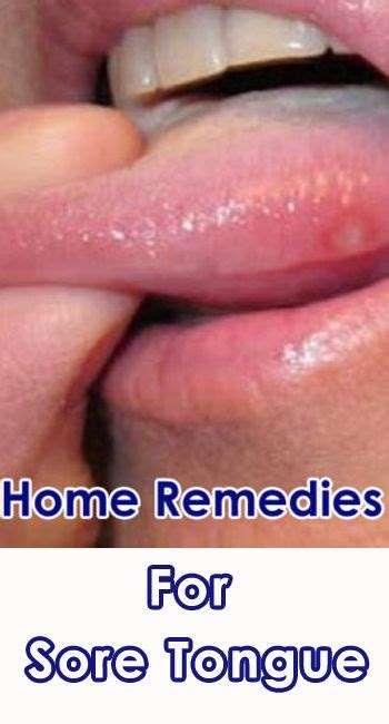 Home Remedies for Treating Sore Tongue - Getinfopedia.com | Tongue sores, Tongue ulcer remedies ...