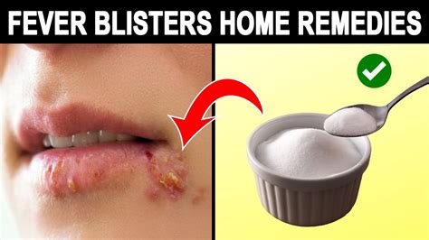 12 Amazing Home Remedies For Fever Blisters In Mouth - YouTube