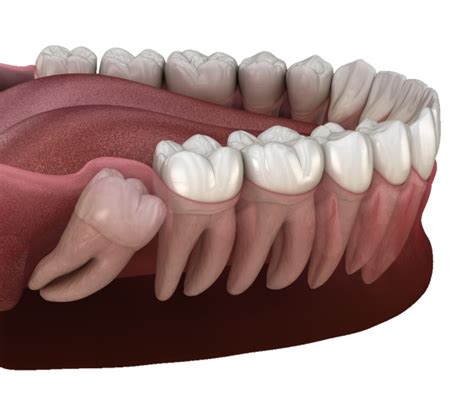 Benefits of Wisdom Tooth Removal in Rocky Mountain House – Redd community