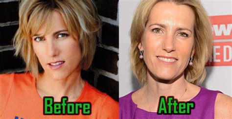 Laura Ingraham: Plastic Surgery for Facelift? Before-After Photos ...