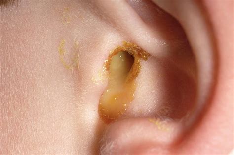 Ear Infection Photograph by Dr P. Marazzi/science Photo Library