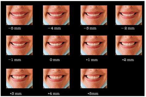 Medicina | Free Full-Text | The Influence of Gingival Exposure on Smile ...