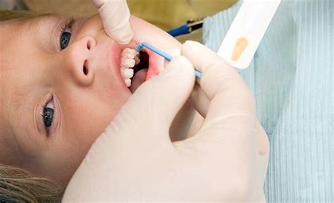 Vecni Fluor Enamel Pro Varnish ngăn ngừa và dự phòng sâu răng của Mỹ