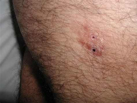 Dermatofibrosarcoma protuberans - Dermatology Advisor