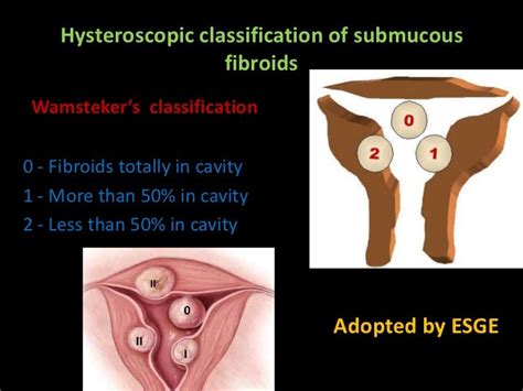 Hysteroscopic classification of submucous fibroids