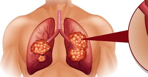 Treatment For Lung Cancer Stage 4 - CancerOz