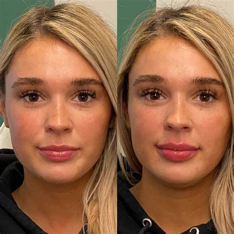 Dermal Fillers Lips Before And After | Lipstutorial.org