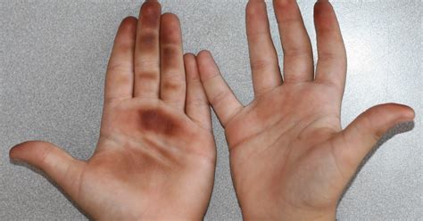 Dermapixel: Manchas marrones en las palmas de las manos