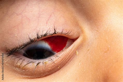 Subconjunctival hemorrhage, macro of blood in a child's red eye Stock ...