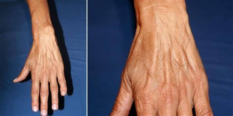 Hand Vein Causes & Treatments - San Diego Cardiac Vein and Laser Center