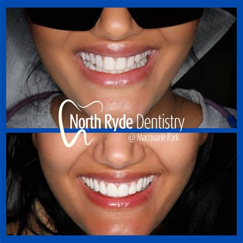 Emax BL2-LT veneers | Dentists in North Ryde | North Ryde Dentistry