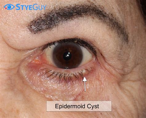 Eyelid Cyst