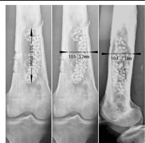 One-stage surgery for adult chronic osteomyelitis: concomitant use of ...