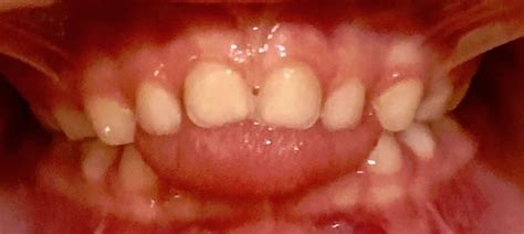 What is a Tongue Thrust? – Myofunction Junction