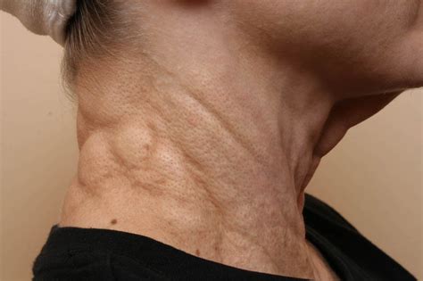 Pseudoxanthoma Elasticum (Groenblad Strandberg Syndrome) - Dermatology Advisor