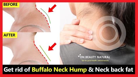 (Work 100%) How to get rid of Neck Hump, fix buffalo neck hump, fix back neck fat | 3 Easy ...