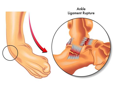 Lateral Ankle Sprain Mechanism Of Injury