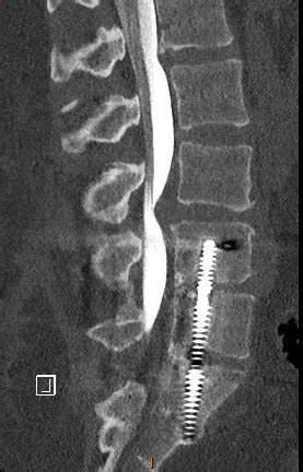 Revision Surgery after Failed Axialif | Houston Scoliosis & Spine Institute