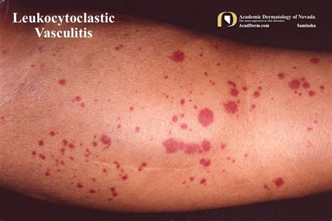 Leukocytoclastic Vasculitis: Small-Vessel Vasculitis... - Academic ...