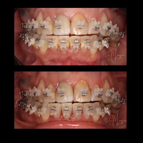 Pin on Periodontal disease