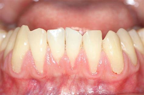 Overview of Receding Gums: Symptoms, Causes & Prevention