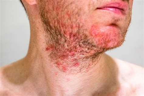 Beard Rash: A Four-Step Guide To Soothe and Prevent Future Breakouts | Beard Club – The Beard Club